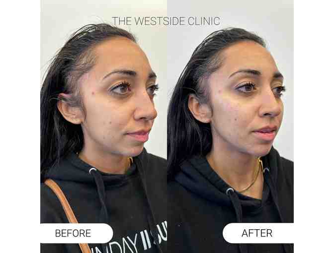 The Westside Clinic - 50 Units of Botox